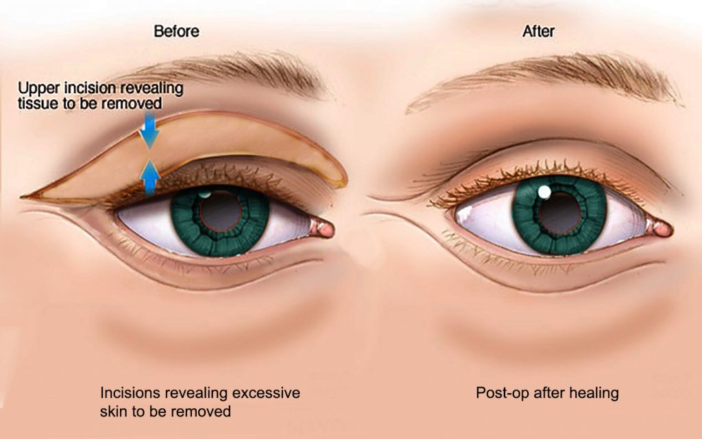 Eye Procedures Harbin Clinic